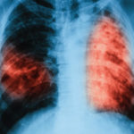 KP.com TB Tuberculosis