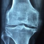 world arthritis day 2018 Knee