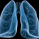 lungs cancer 1