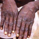 Europe Briten No Coronavirus but its infected humans New Monkeypox Virus 2