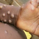 Europe No Coronavirus but its infected humans New Monkeypox Virus
