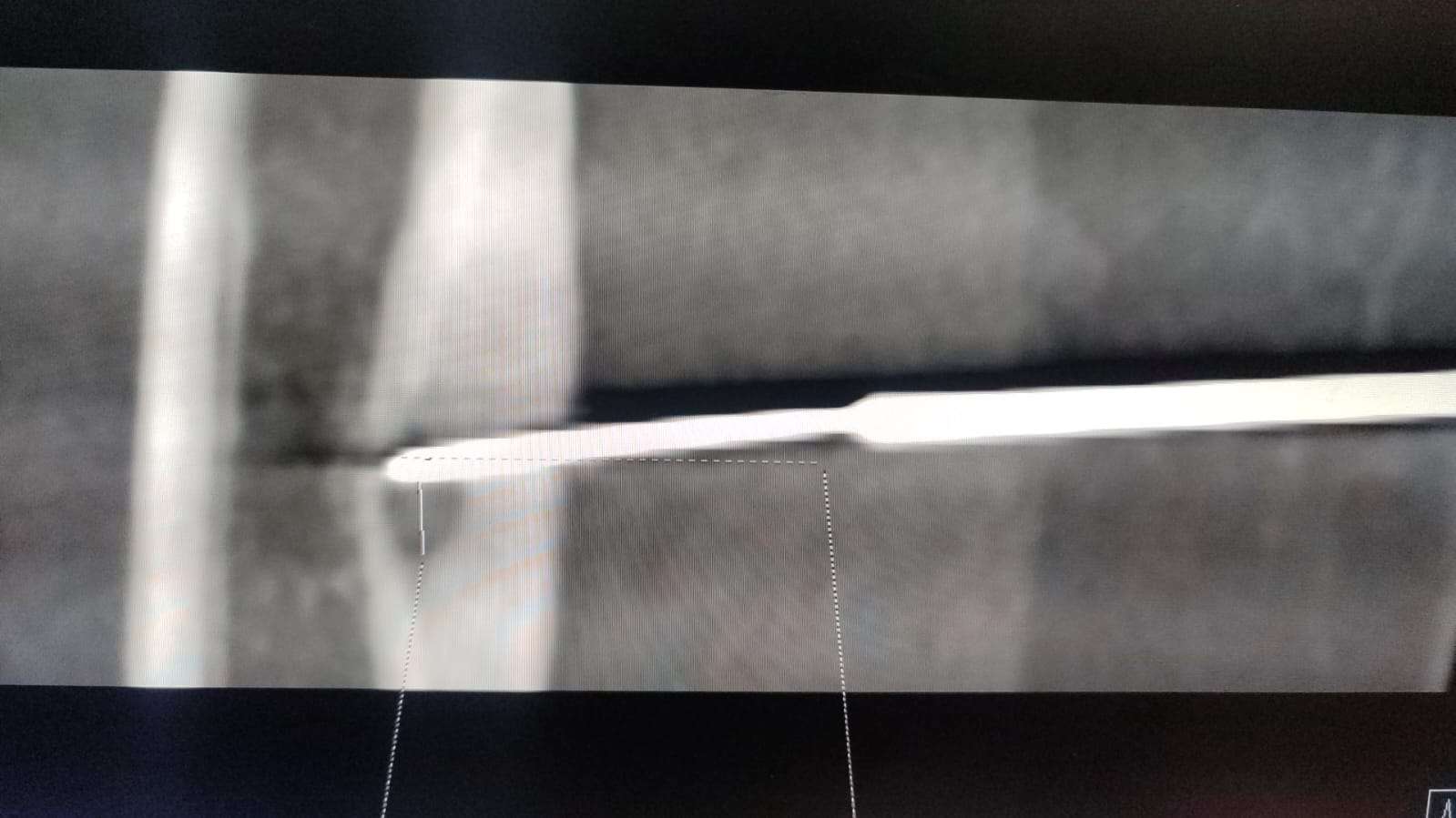 12 વર્ષના બાળકના હાડકાનું ટ્યુમરને ઈન્ટરવેન્શનલ રેડીયોલોજીની લેટેસ્ટ ટેક્નોલોજી ની મદદથી કાપા વગર દૂર કરવામાં આવ્યું 1 By Dr. Vikas Jain 1