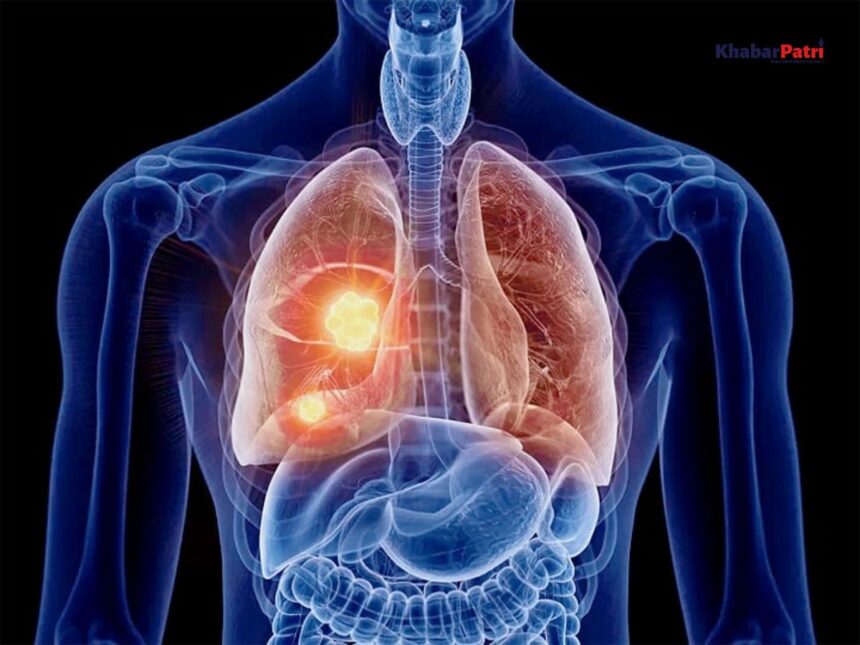 વર્લ્ડ લંગ કેન્સર ડે : ફેફ્સાના કેન્સરની સારવાર માટે ગુજરાત બન્યું રાષ્ટ્રીય કેન્દ્ર, ૫ વર્ષમાં ૪,૩૯૭ દર્દીઓને મળ્યું જીવનદાન 1 WLC